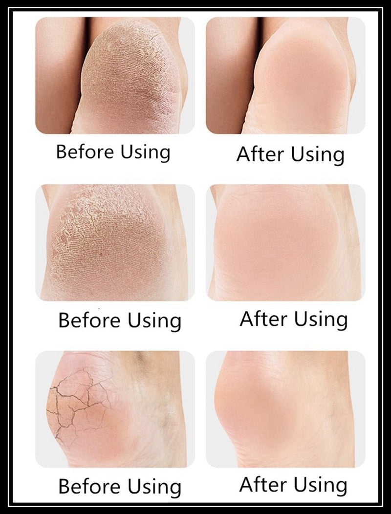 Heal Cover/ Heal Protector Silicone
